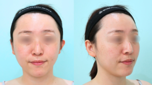 『輪郭施術で垢抜けを。本来の美しさを引き出す『顔の脂肪吸引』。』の画像