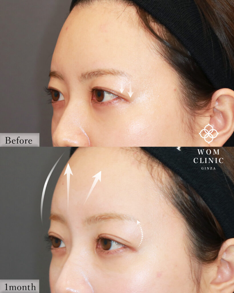 『【症例解説】内視鏡額挙上で優しい目元へ。驚いた目にならないプロの技術』の画像