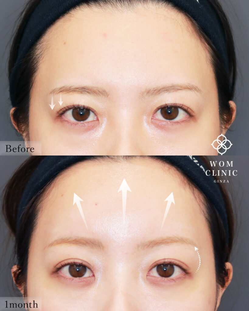 『【症例解説】内視鏡額挙上で優しい目元へ。驚いた目にならないプロの技術』の画像