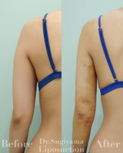 『二の腕脂肪吸引のダウンタイムの個人差を決める要素は！？』の画像