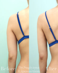 『【1ヶ月でカタチにする】ナチュラル派の二の腕脂肪吸引脂肪吸引』の画像