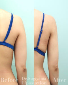 『【1ヶ月でカタチにする】ナチュラル派の二の腕脂肪吸引脂肪吸引』の画像