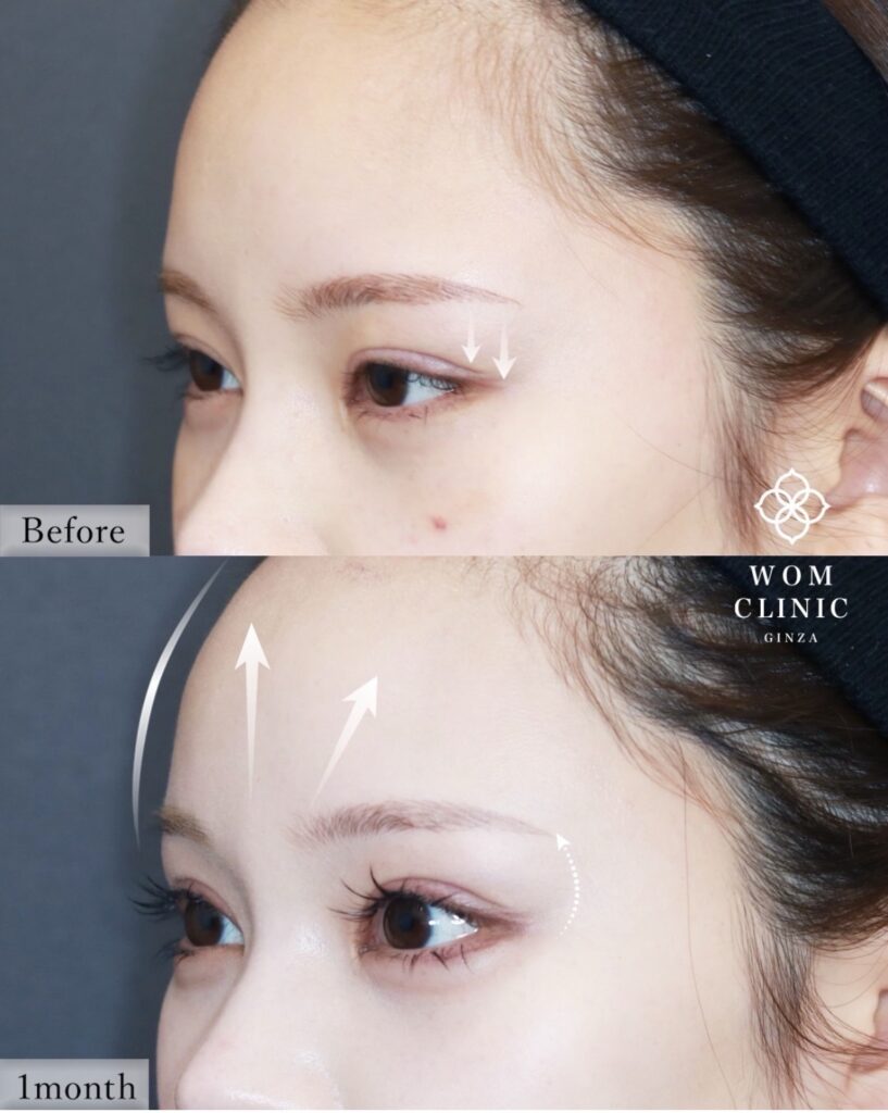 『【SNSで大バズり!】内視鏡額挙上だからできる変化。二重整形では届かない「優しさ」を。』の画像