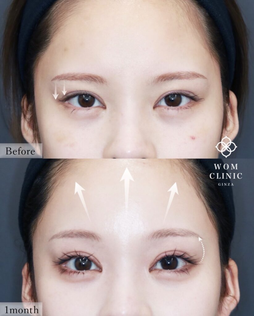 『【SNSで大バズり!】内視鏡額挙上だからできる変化。二重整形では届かない「優しさ」を。』の画像