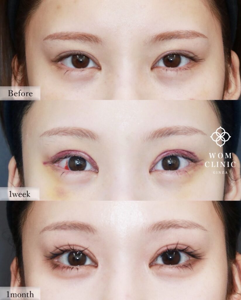 『【SNSで大バズり!】内視鏡額挙上だからできる変化。二重整形では届かない「優しさ」を。』の画像