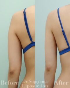 『二の腕脂肪吸引のダウンタイムの個人差を決める要素は！？』の画像