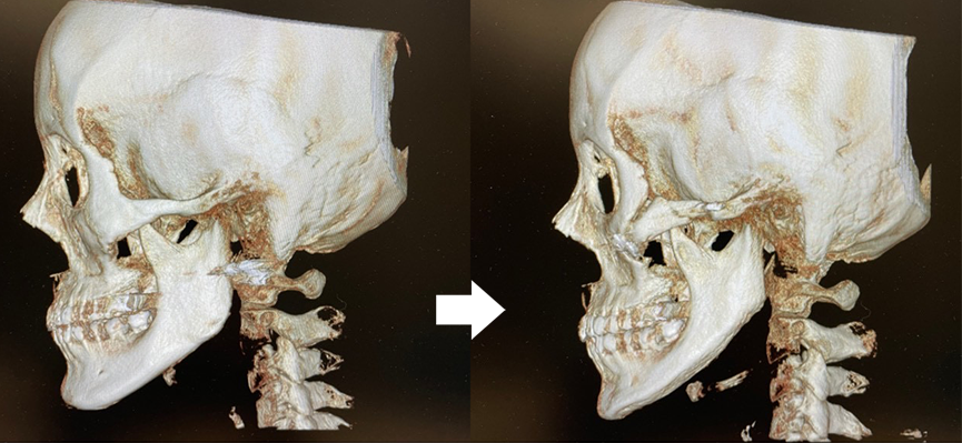 『自然に整える輪郭形成 輪郭3点骨切り×脂肪吸引』の画像