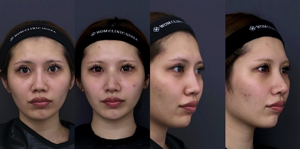 『【初回鼻整形】鼻先の丸みと高さを整える ACRバランスを調整し、自然で洗練された鼻へ』の画像