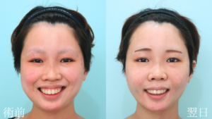 『脱丸顔へ『下顔面』をスッキリさせるフルコース』の画像