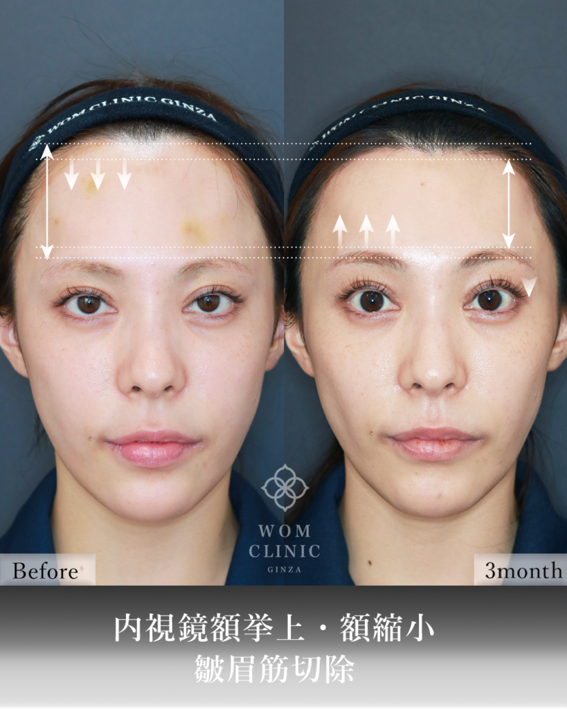 『広い額を狭く、重い目元を明るく。内視鏡額挙上×額縮小の相乗効果』の画像