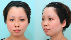 『脱丸顔へ『下顔面』をスッキリさせるフルコース』の画像