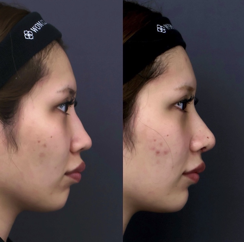 『【初回鼻整形】鼻先の丸みと高さを整える ACRバランスを調整し、自然で洗練された鼻へ』の画像