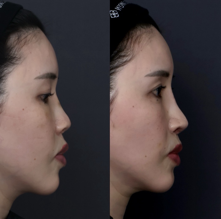 『【重度鼻修正】肋軟骨手術後の鼻の穴の見えすぎを改善 自家組織で鼻の構造を再建した修正鼻整形』の画像
