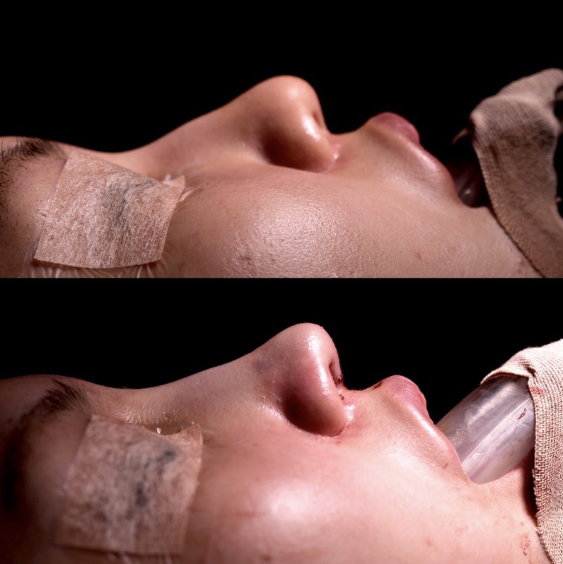 『【初回鼻整形】鼻先の丸みと高さを整える ACRバランスを調整し、自然で洗練された鼻へ』の画像