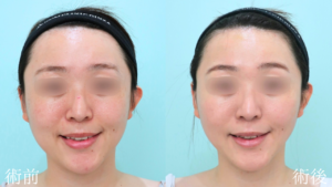 『輪郭施術で垢抜けを。本来の美しさを引き出す『顔の脂肪吸引』。』の画像