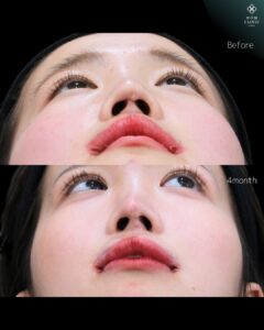 鼻形成術前後の鼻孔と鼻柱の状態2