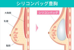 豊胸手術によるシリコンバッグ挿入の図