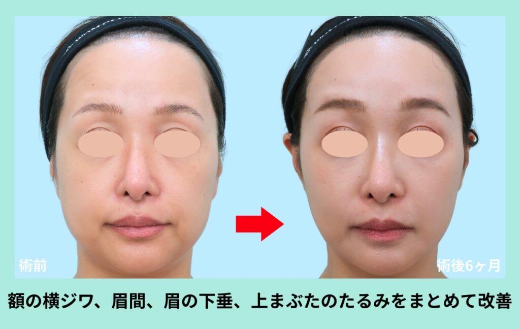 前額リフト術後写真