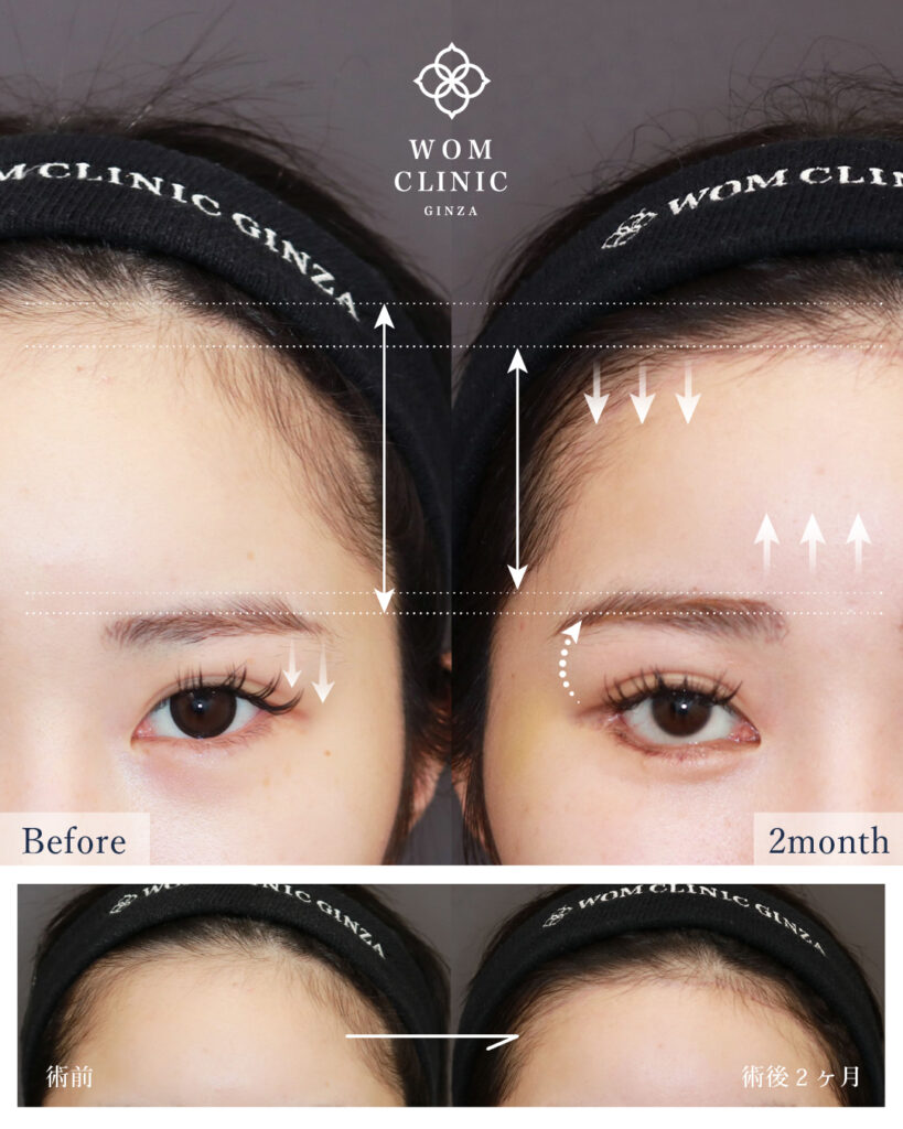 『【最新技術の融合】「おでこを広くしたくない」方へ。内視鏡額挙上・額縮小術を解説』の画像