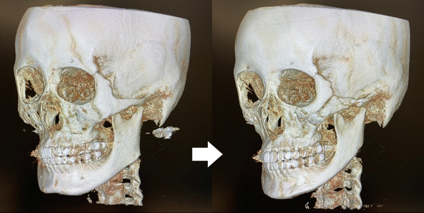 『自然に整える輪郭形成 輪郭3点骨切り×脂肪吸引』の画像