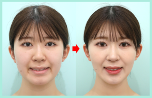 頬・顎下の脂肪吸引のビフォーアフター