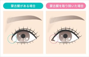 目頭の蒙古襞がある場合とない場合の比較