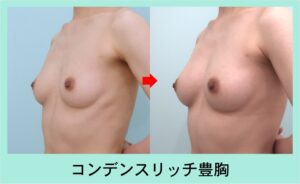 コンデンスリッチ豊胸のビフォーアフター