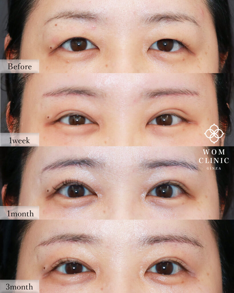 『【施術の組み合わせは、アップセルではない!】全体バランスを整える究極の目元整形』の画像