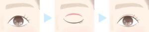 一重まぶたを二重まぶたにするイラスト