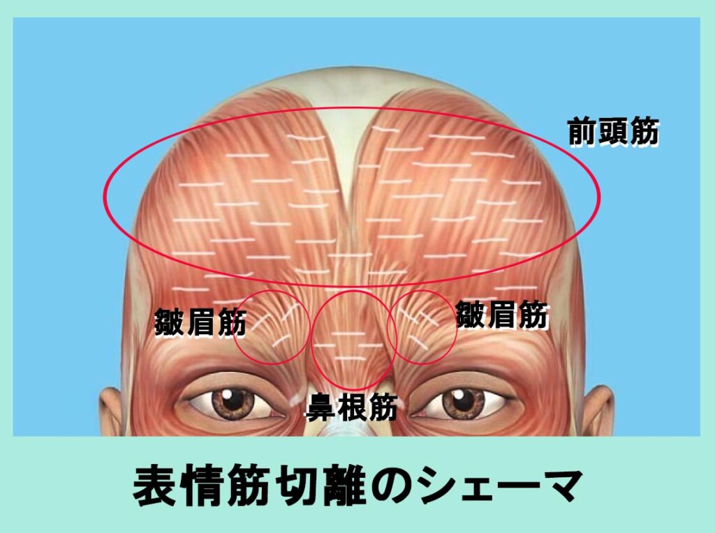 前額リフト表情筋切離シェーマ