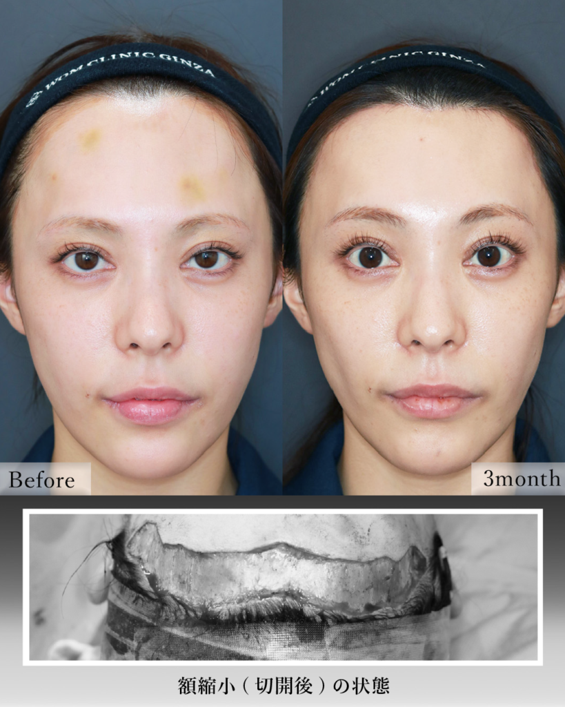 『広い額を狭く、重い目元を明るく。内視鏡額挙上×額縮小の相乗効果』の画像