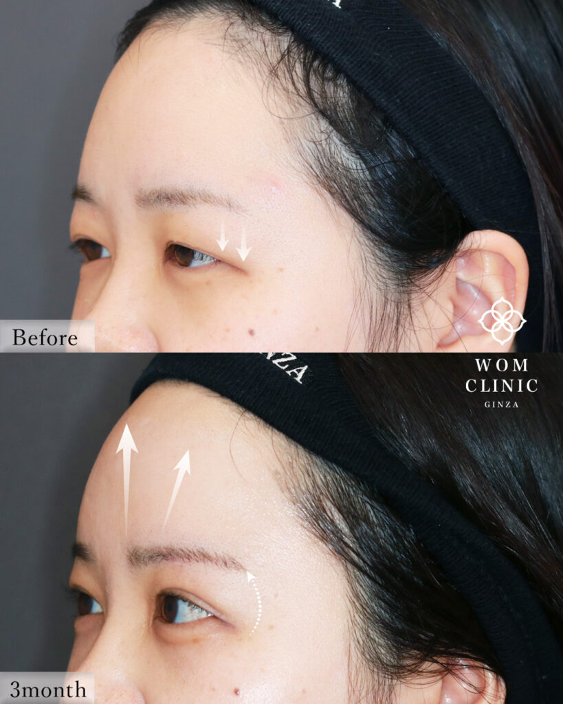 『【施術の組み合わせは、アップセルではない!】全体バランスを整える究極の目元整形』の画像