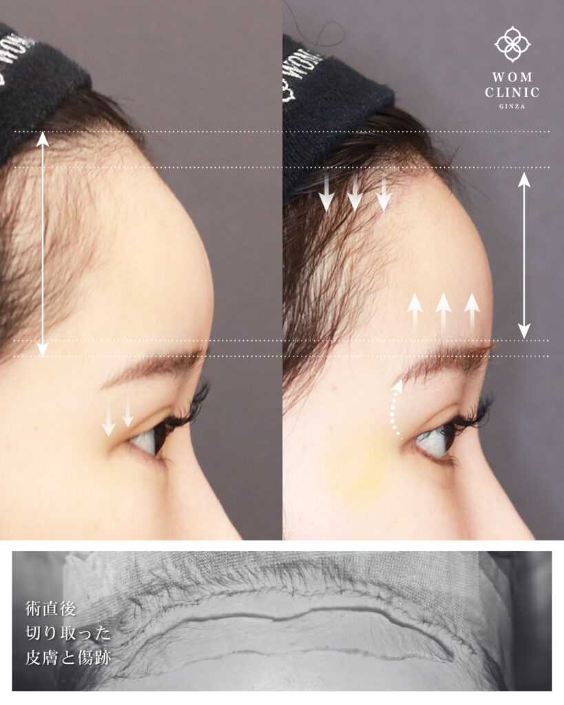 『【最新技術の融合】「おでこを広くしたくない」方へ。内視鏡額挙上・額縮小術を解説』の画像