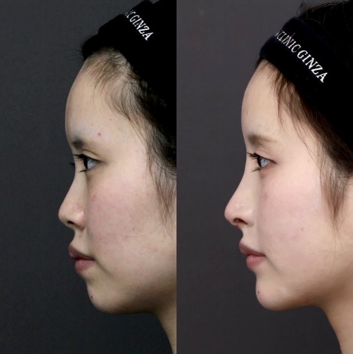 『【鼻の長さで顔の印象は変わる】 可愛いから綺麗へ ― 鼻の長さをデザインする鼻整形』の画像