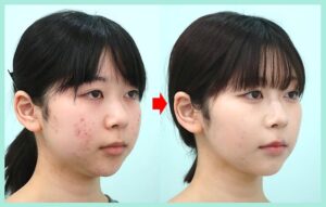 小顔治療のビフォーアフター