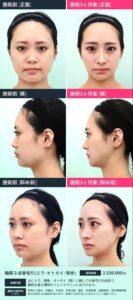 輪郭形成術前と術後3ヶ月の比較画像