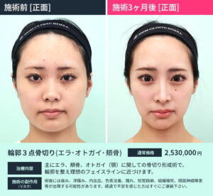 輪郭3点のビフォーアフター1