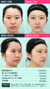 輪郭3点のビフォーアフター2