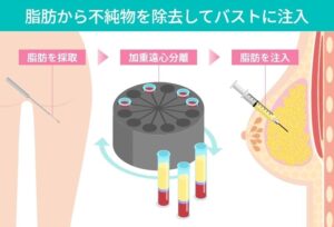 脂肪を採取し遠心分離後にバストへ注入する図
