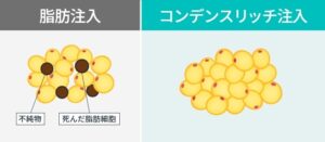 脂肪注入とコンデンスリッチ注入の比較図