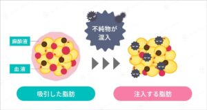 脂肪注入における不純物混入の図