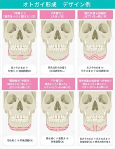 オトガイ形成デザイン例と下顎骨の切除ライン図