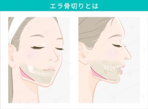 エラ骨切り術の正面と側面の比較図