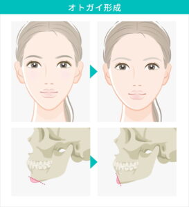 顎の骨格変化と顔貌比較