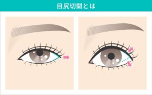 目尻切開前後の目の比較