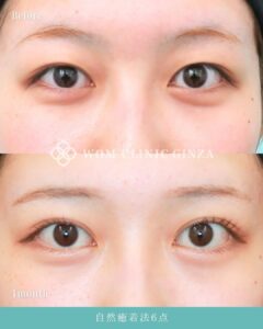 自然癒着法のビフォーアフター