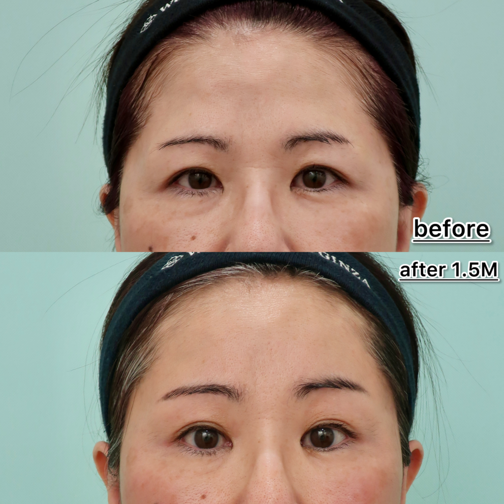 『【眉下切開どう違う？】内視鏡額挙上で額と鼻根部のシワを同時に改善』の画像