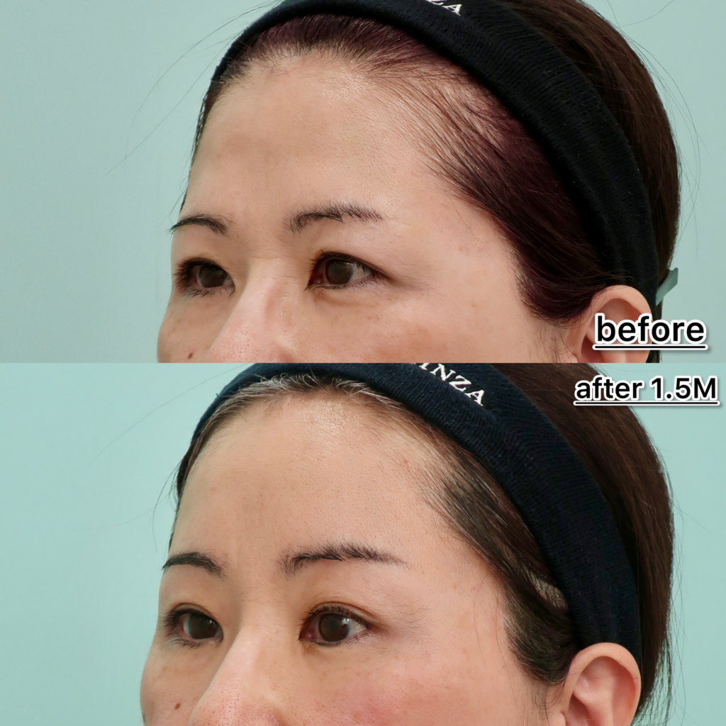 『【眉下切開どう違う？】内視鏡額挙上で額と鼻根部のシワを同時に改善』の画像