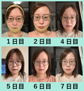 女性の顔の経過写真1日目から7日目