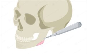 下顎骨に器具を挿入する頭蓋骨のイラスト